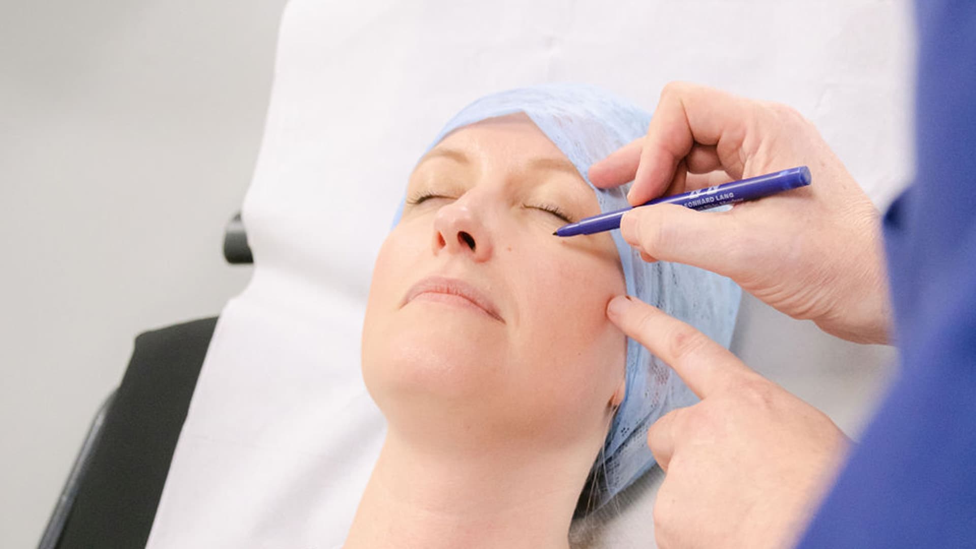 blephoplasty-surgery-marker-pen