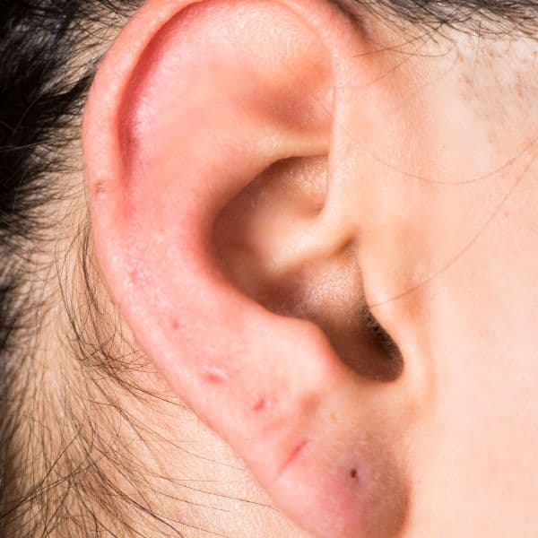 stretched-ear-ring-marks