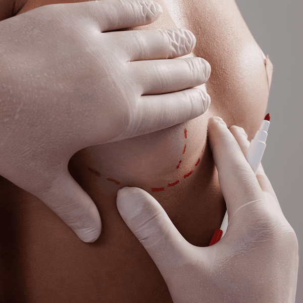 pen-marks-breast-before-surgery