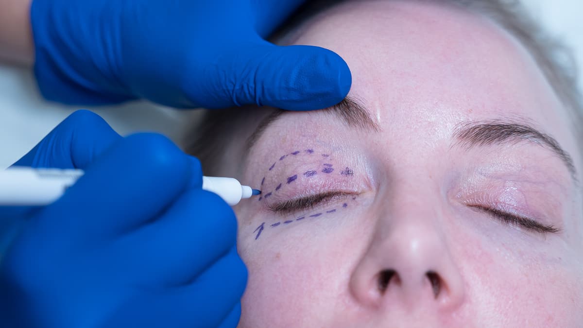 Bleph-treatment-london