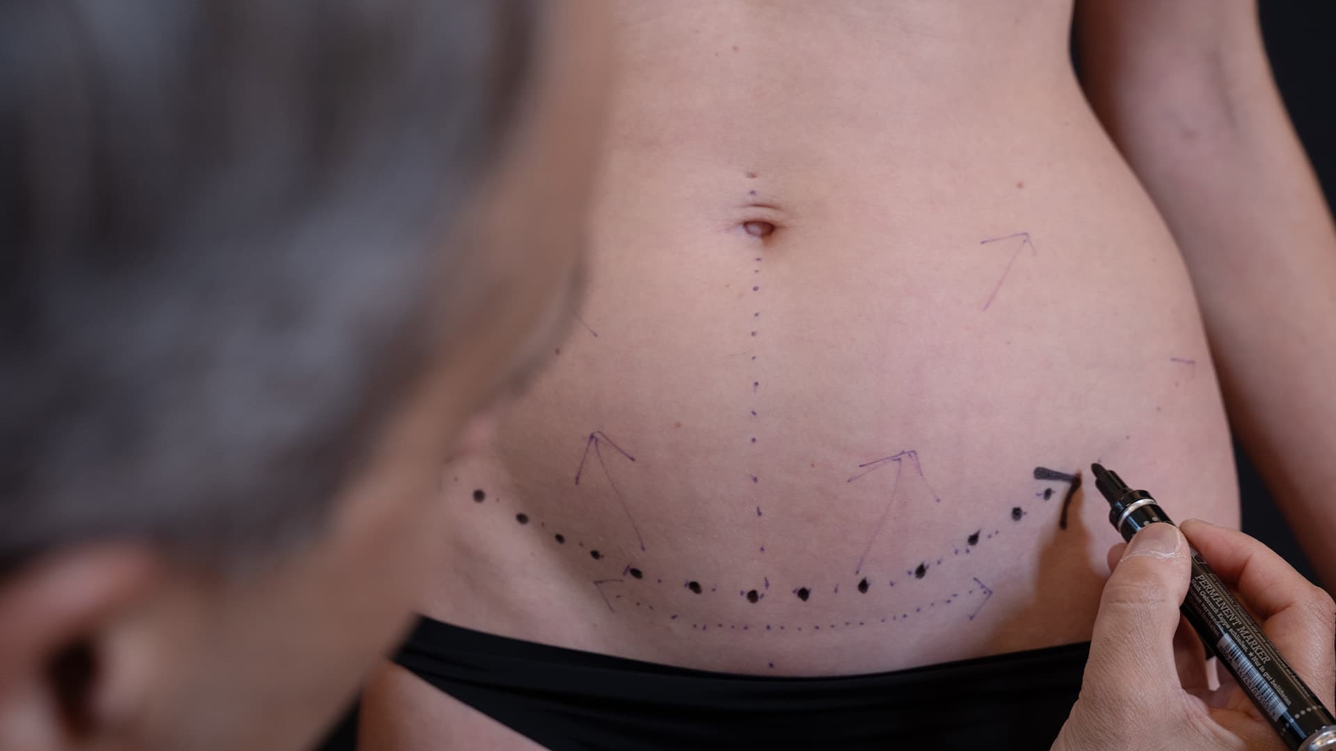 Liposuction-treatment-harley-street