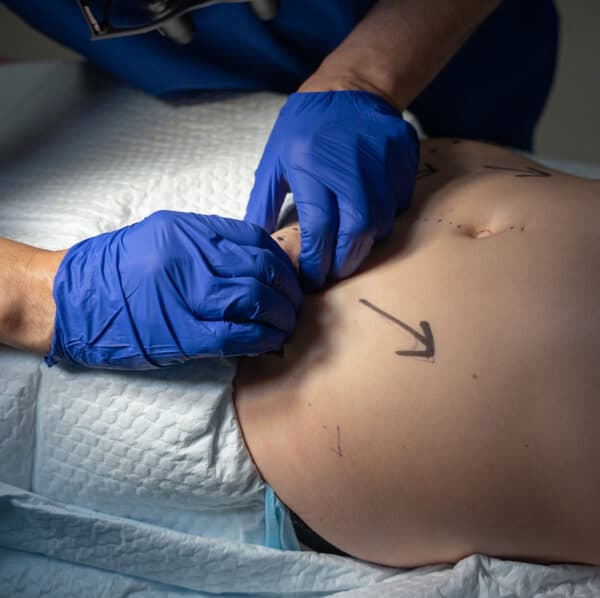 liposuction-101harleystreet
